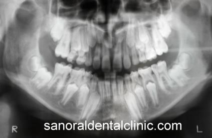 A gyermekkorban készülő digitális panorámaröntgen-felvételek hasznosak azért, mert a fogak fejlődése, a fogváltás figyelemmel kísérhető. 
