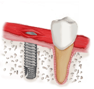 Behajtjuk a fogászati implantátumot az előkészített csontüregbe. 