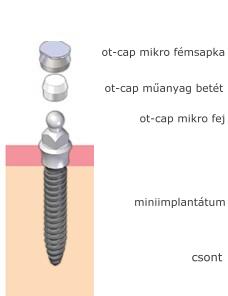 miniimplant1